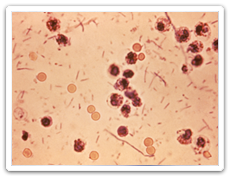 Shigellose (Shigella spp.)